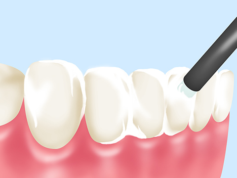 フッ素塗布で歯を強く