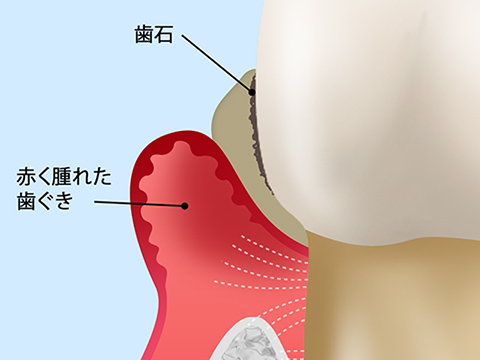 妊娠性歯周炎