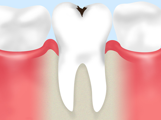 むし歯の原因