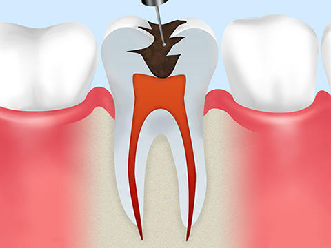 根管治療とは