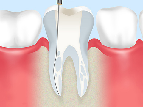 根管治療には根気が必要です