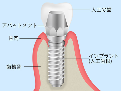 インプラント治療