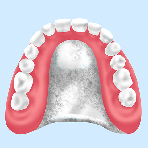 金属床義歯(ゴールド、チタン、コバルトクロム)