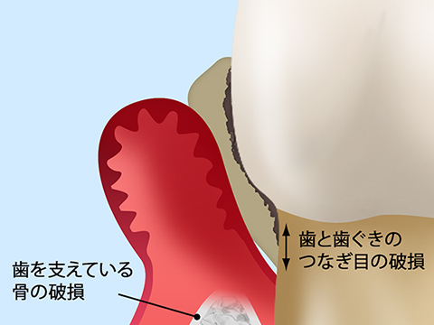 歯周病治療