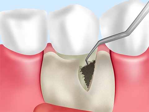 フラップ手術（歯周外科治療）